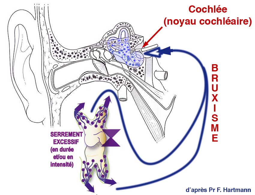 Acouphènes, Prurit de l'Oreille et Bruxisme | Serrement de Dents ...